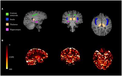 Examining temporal features of BOLD-based cerebrovascular reactivity in clinical populations